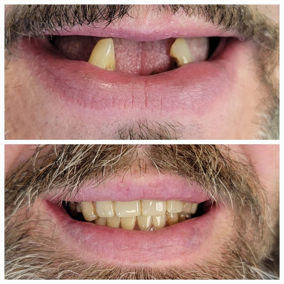 Implants & crowns before and after by Dr. Jain at Smile Studio Boston