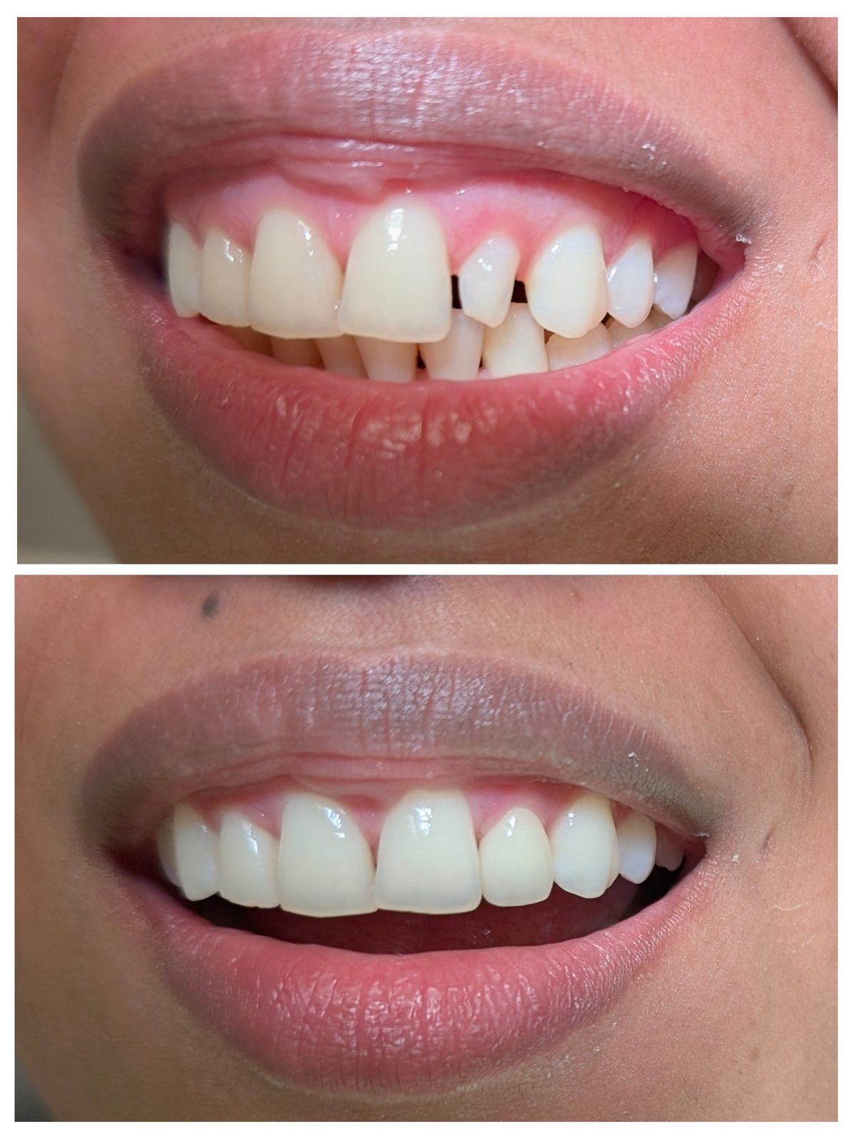 Smile restoration before and after by Dr. Jain at Smile Studio Boston