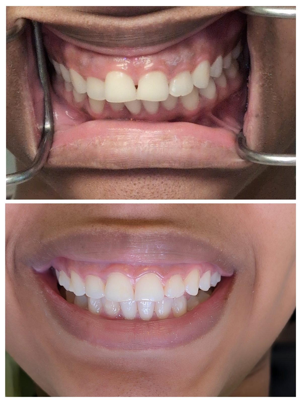 Smile restoration before and after by Dr. Jain at Smile Studio Boston