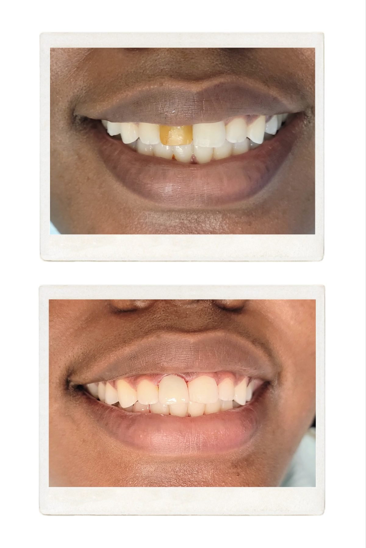 Smile restoration before and after by Dr. Jain at Smile Studio Boston