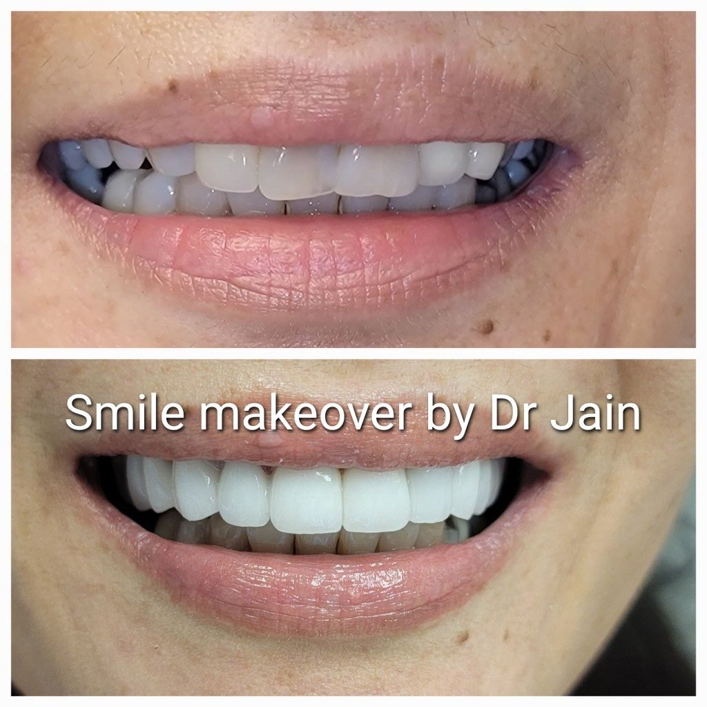 Smile makeover before and after by Dr. Jain at Smile Studio Boston