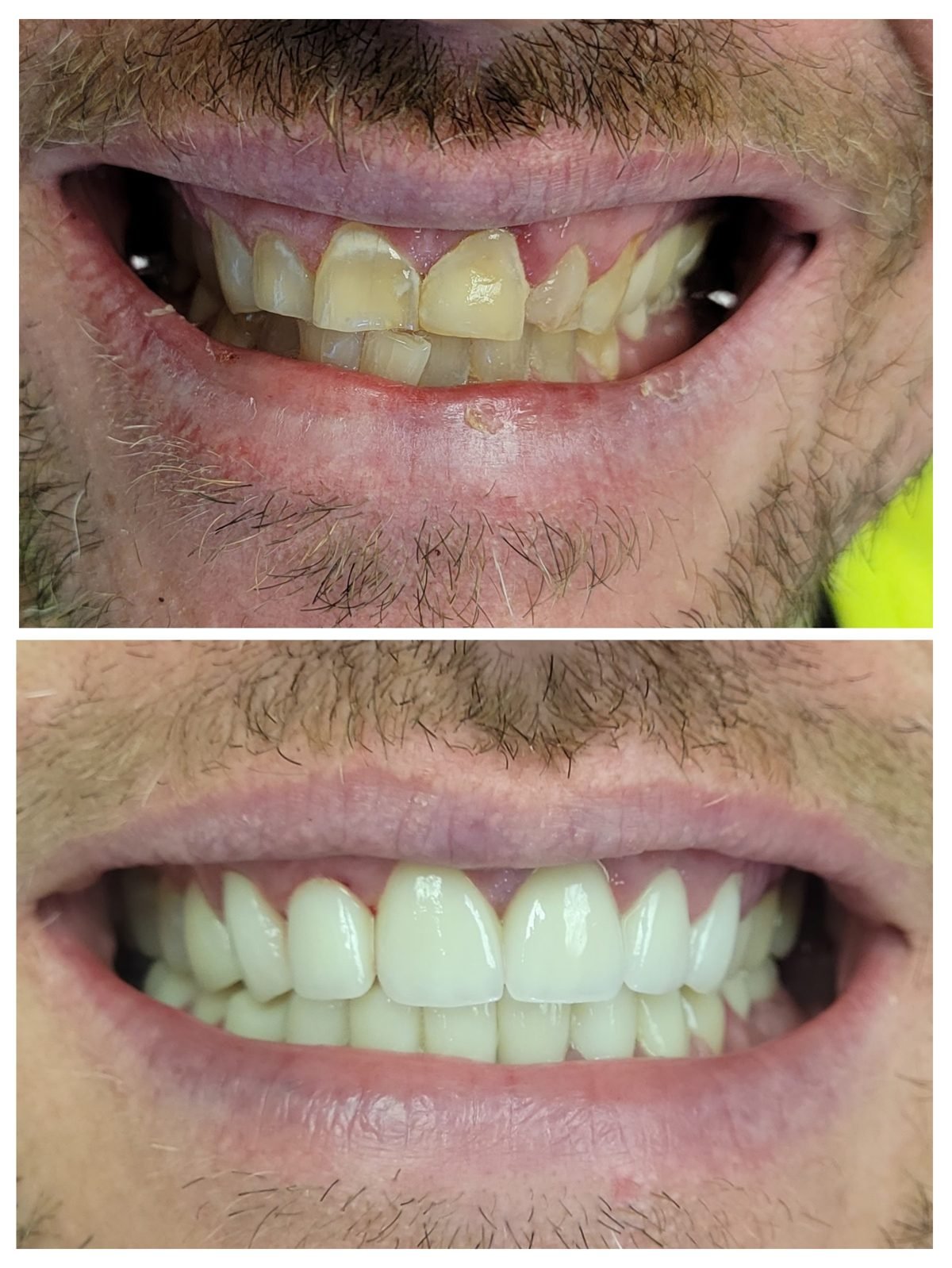 Smile makeover before and after by Dr. Jain at Smile Studio Boston