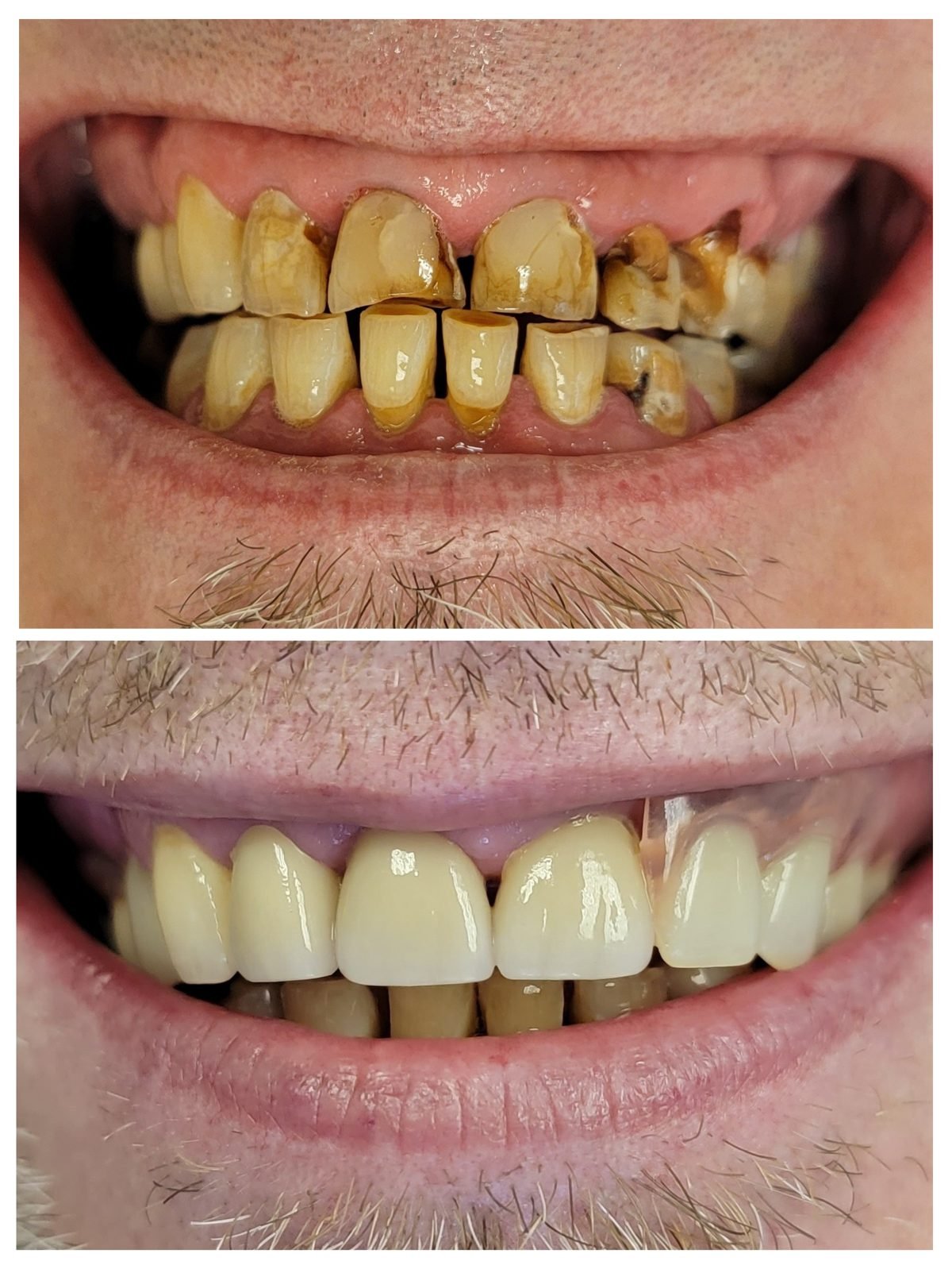 Porcelain veneers before and after by Dr. Jain at Smile Studio Boston