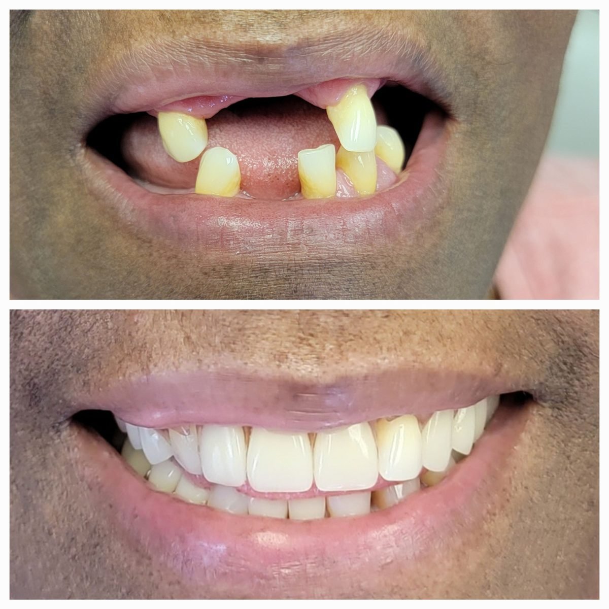 Porcelain veneers before and after by Dr. Jain at Smile Studio Boston