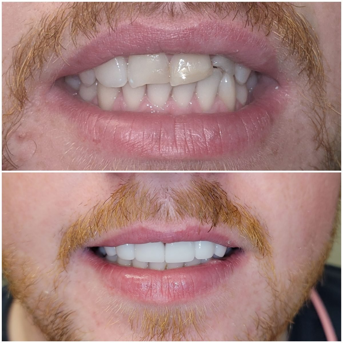 Porcelain veneers before and after by Dr. Jain at Smile Studio Boston